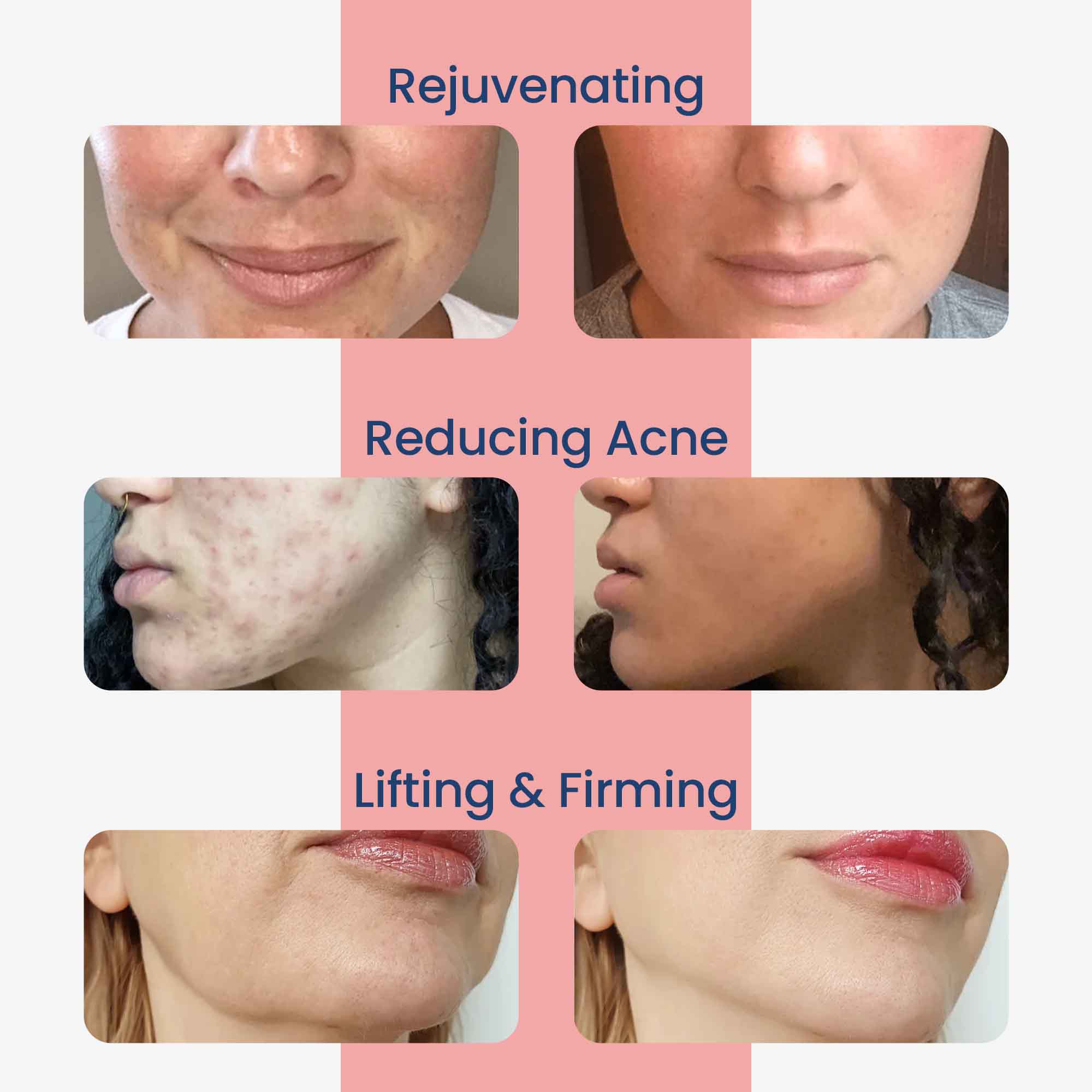 EMS & RF 4 in 1 Face Wand